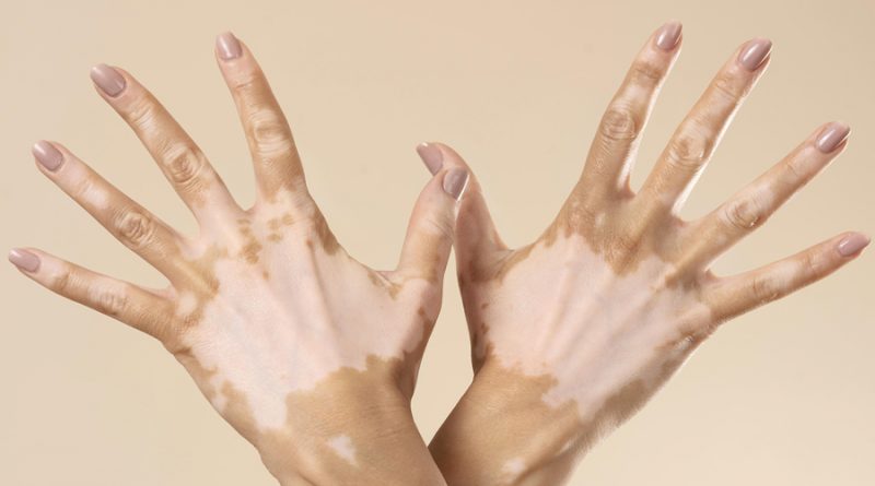 VITILIGO