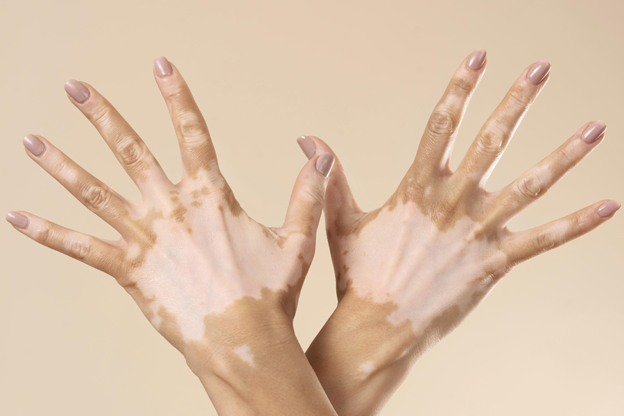 VITILIGO