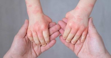 Dermatitis Atópica