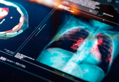 Qué es la tromboembolia pulmonar, una amenaza poco conocida que puede ser mortal PULMON