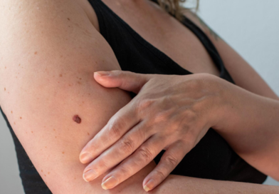 Día Mundial del Melanoma: cómo identificarlo a tiempo